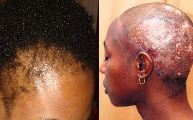 Sknvibes Research Finds Hair Relaxers Link To Fibroids Early